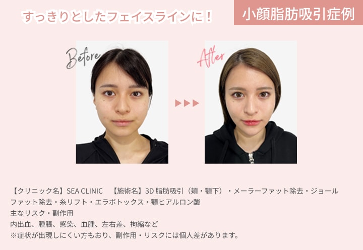 すっきりとしたフェイスラインに!小顔脂肪吸引症例