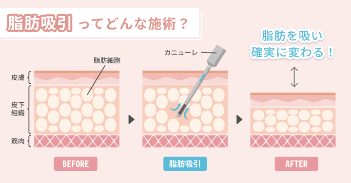 脂肪吸引ってどんな施術?
